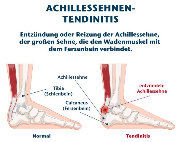 Entzündung Tendinitis der Achillessehne Abbildung