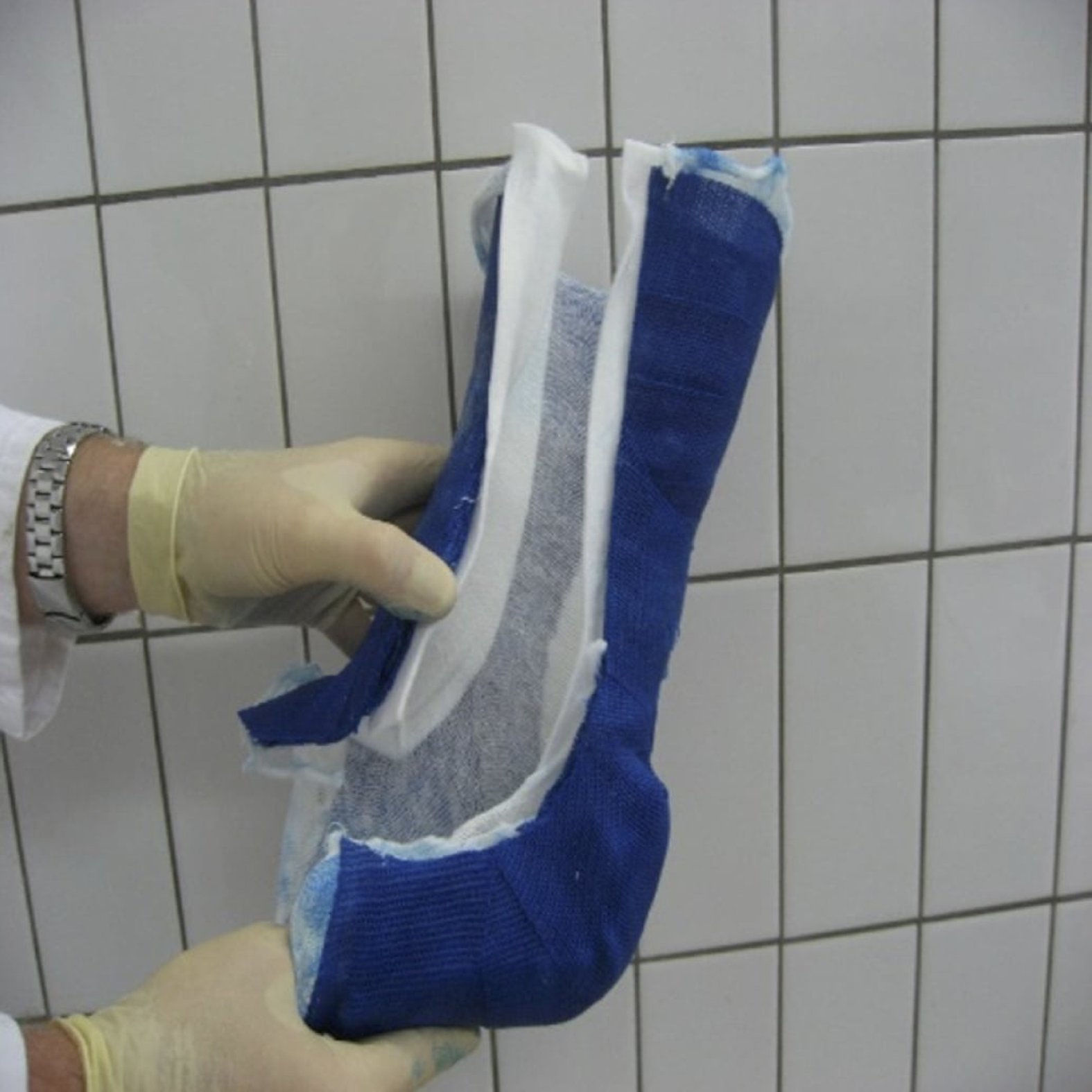 Orthese-Cast geoeffnet