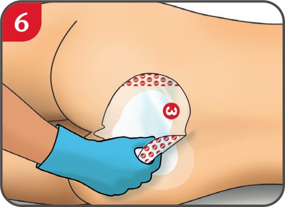 Dracofoam Sakral Anwendung Schritt 6: Entfernen der Schutzfolie