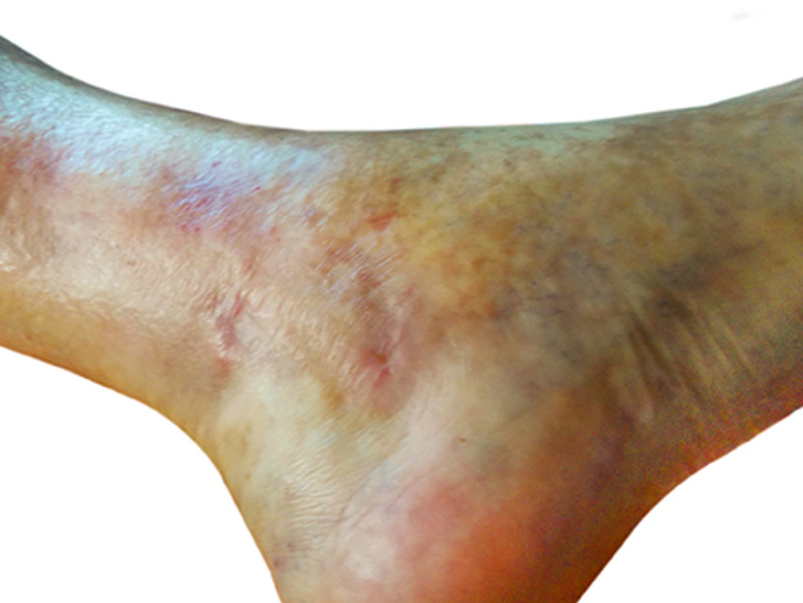 Ulcus Cruris Venosum Heilungsverlauf Stufe 8