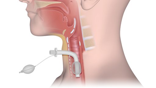 Tracheostoma, schematische Darstellung