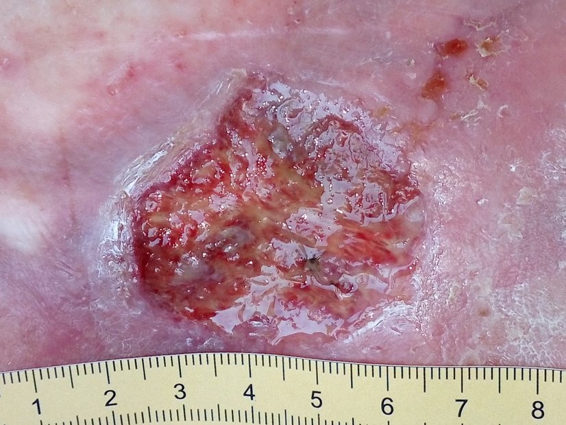 Ulcus cruris venosum, Ausgangssituation (Tag 1)