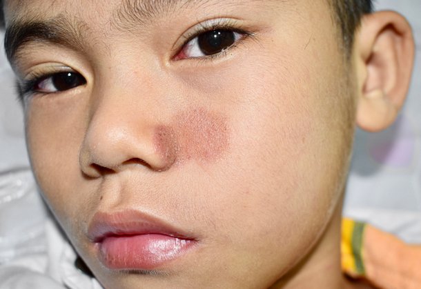 Ringelflechte, Pilzinfekt