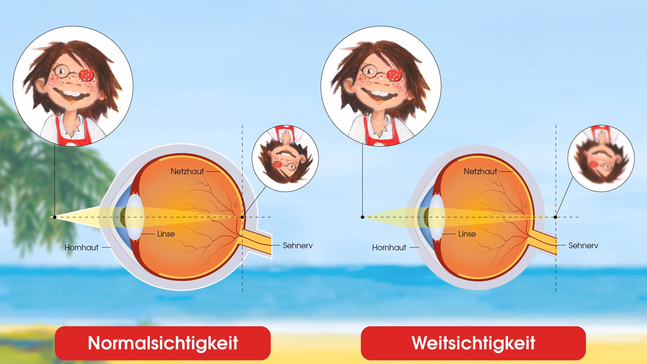Abbildung Lichteintritt bei Normal- und Weitsichtigkeit