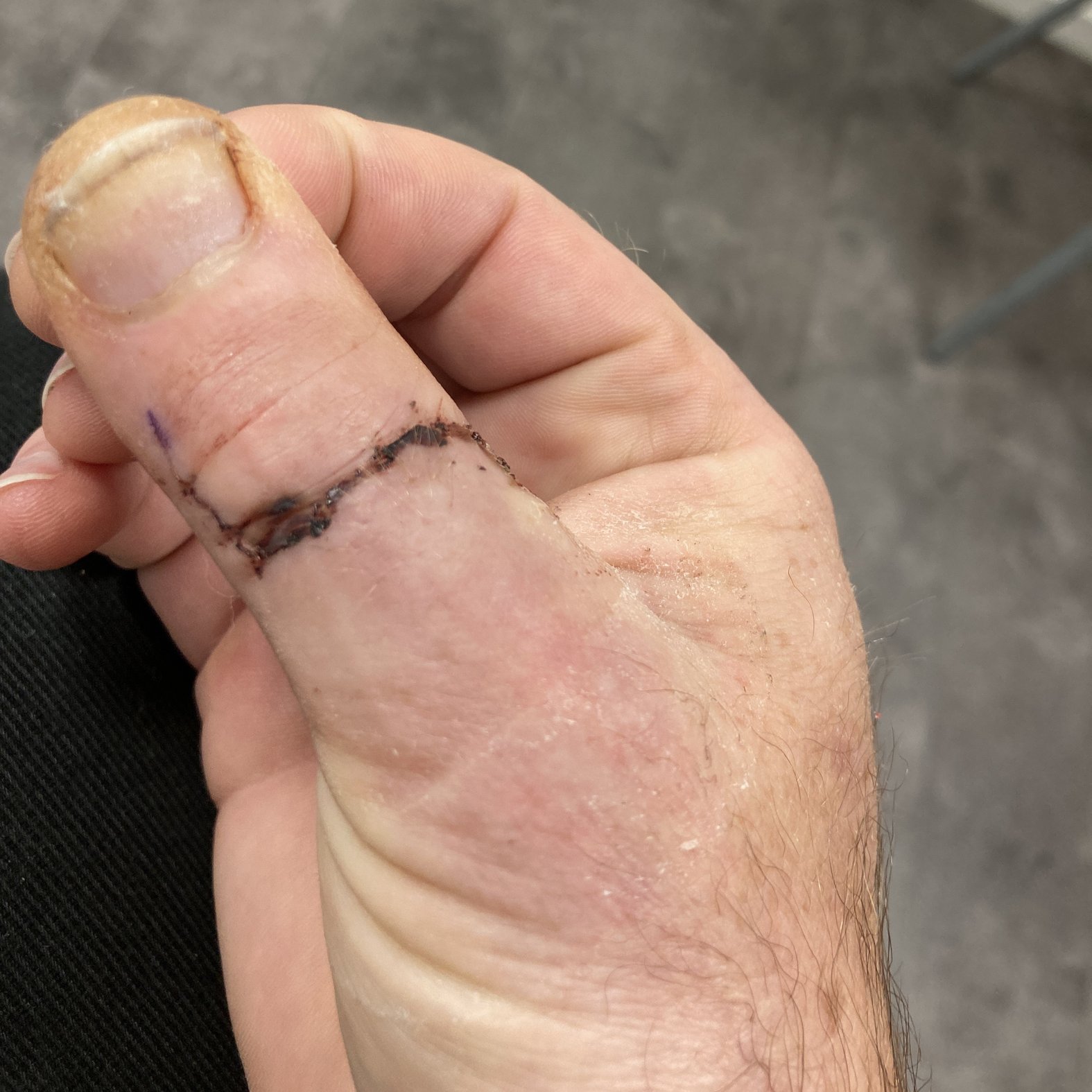 Foto 11: Die Wunde 3 Wochen nach ihrer Entstehung