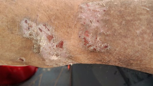 Hilfe… es juckt! Die Behandlung von Krätze in der Praxis