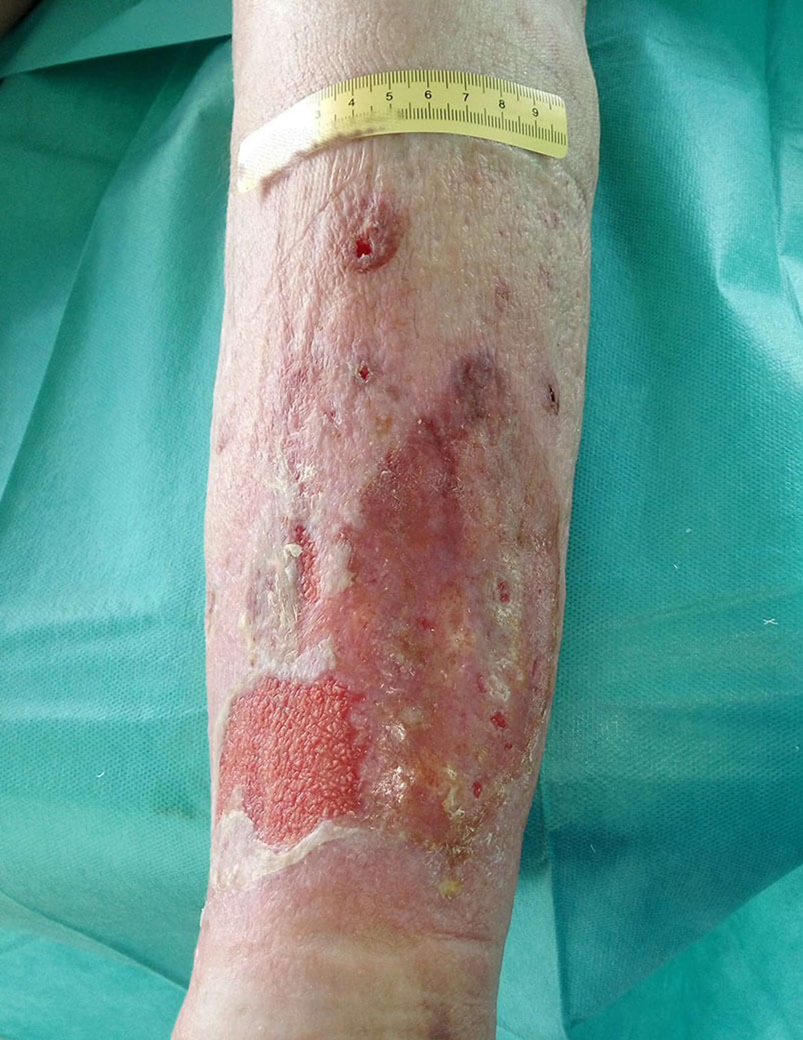 Ulcus cruris venosum nach Trauma