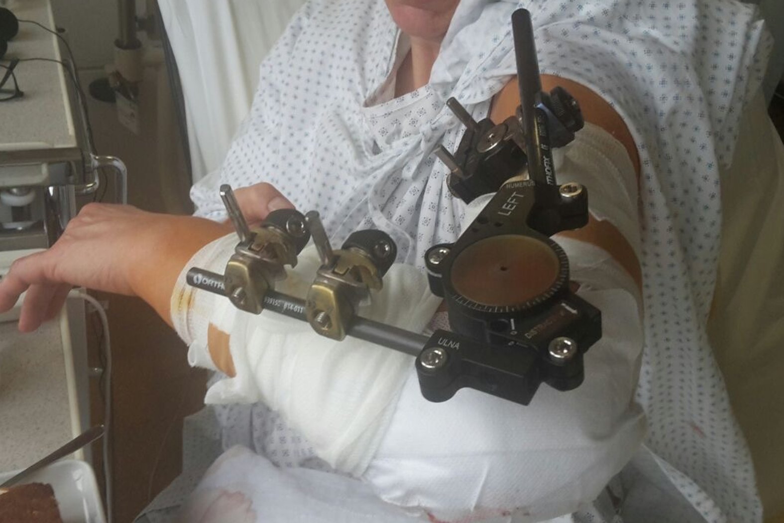 Fixateur externe nach Fraktur, Ellbogen