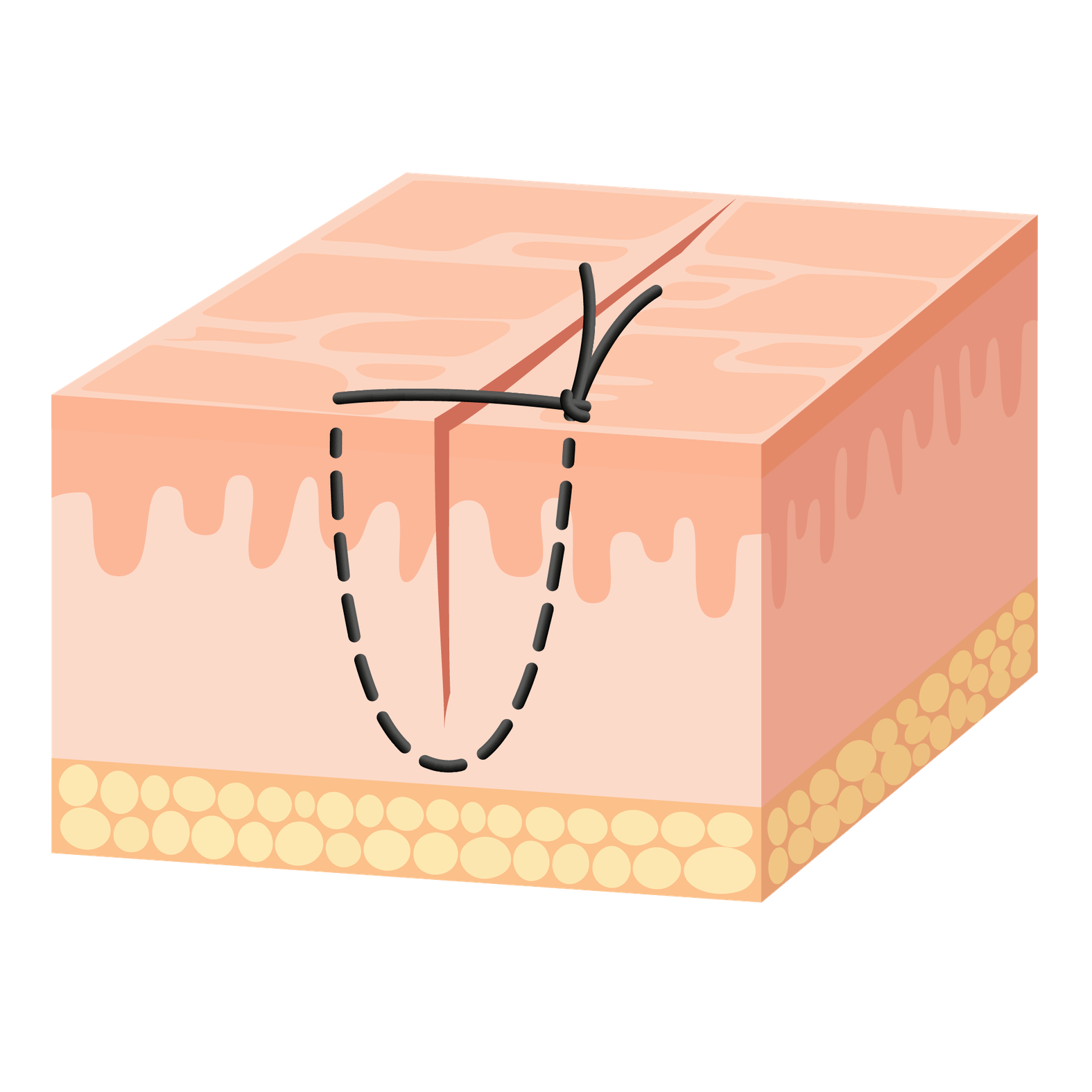 Wundnaht mit einfacher Knopfnaht, Schritt 2