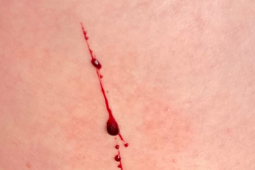 Frische Kratzwunde, leichte Blutung