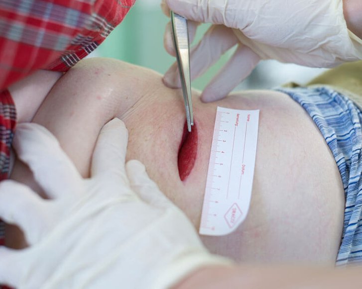 Tiefe Wunde an der Körperseite