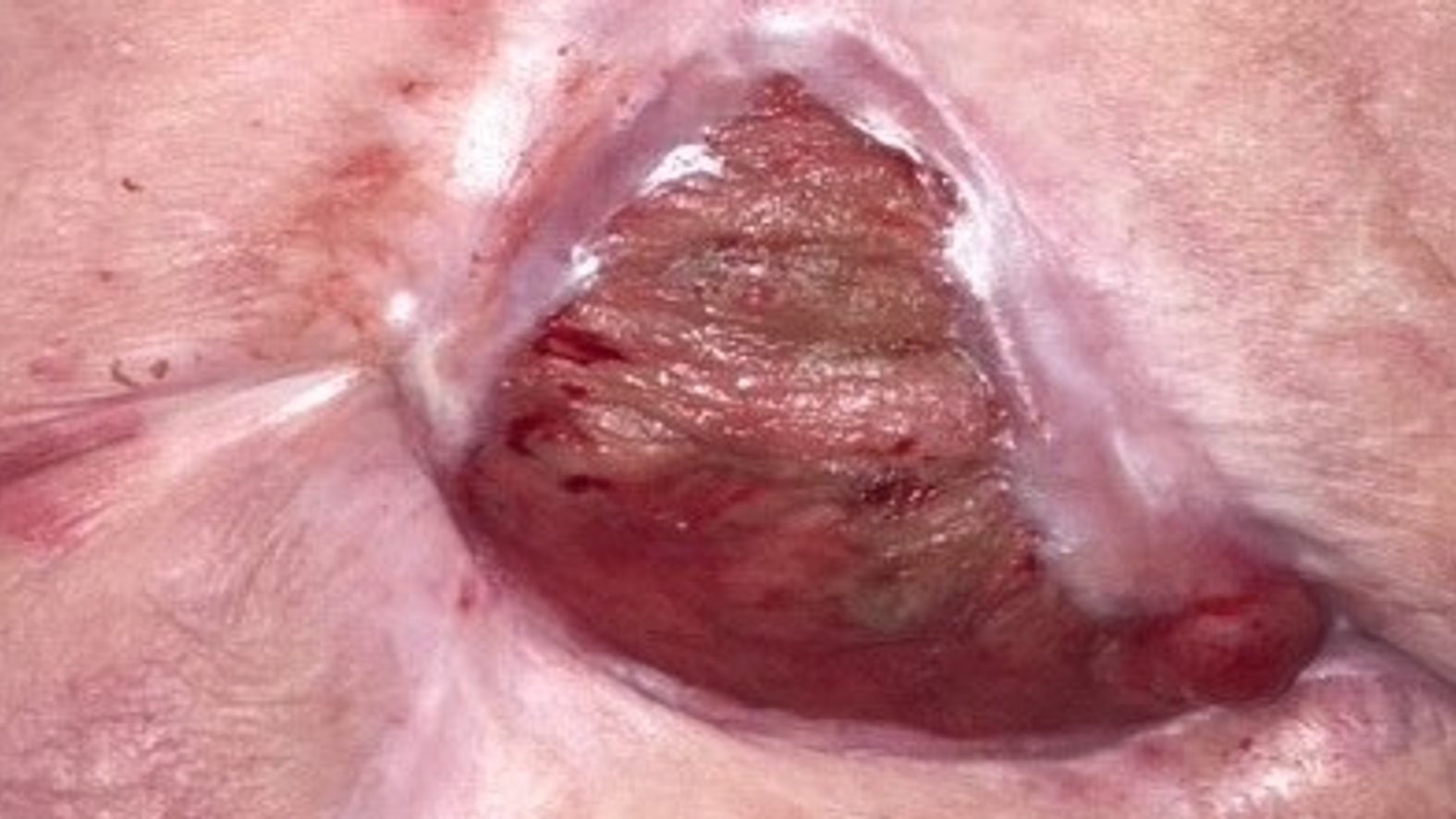 Bauchwunde mit Stomaanlagen – Nach 35 Wochen