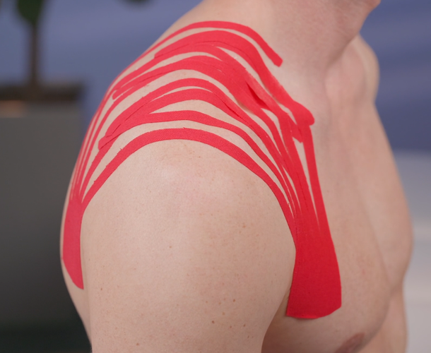 Lymphanlage über Schulterregion