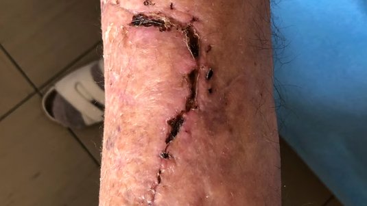 Kurz und kompakt: Ablederungswunden