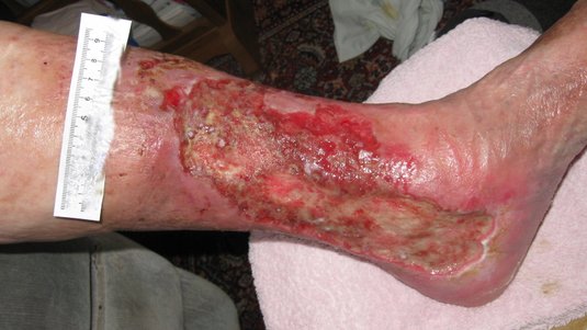 Exsudatmanagement in der Wundversorgung – Pathologische Exsudatproduktion