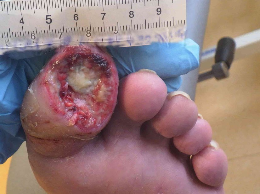 Abszess am Zeh nach Trauma, Tag 1