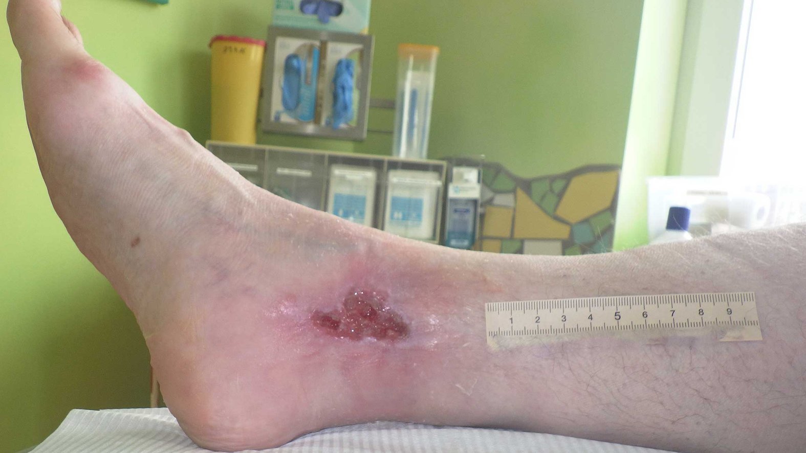 Ulcus cruris arteriosum