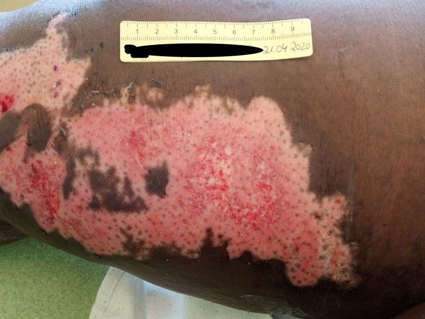 Verbrennung Grad 2a auf stark pigmentierter Haut, Tag 1