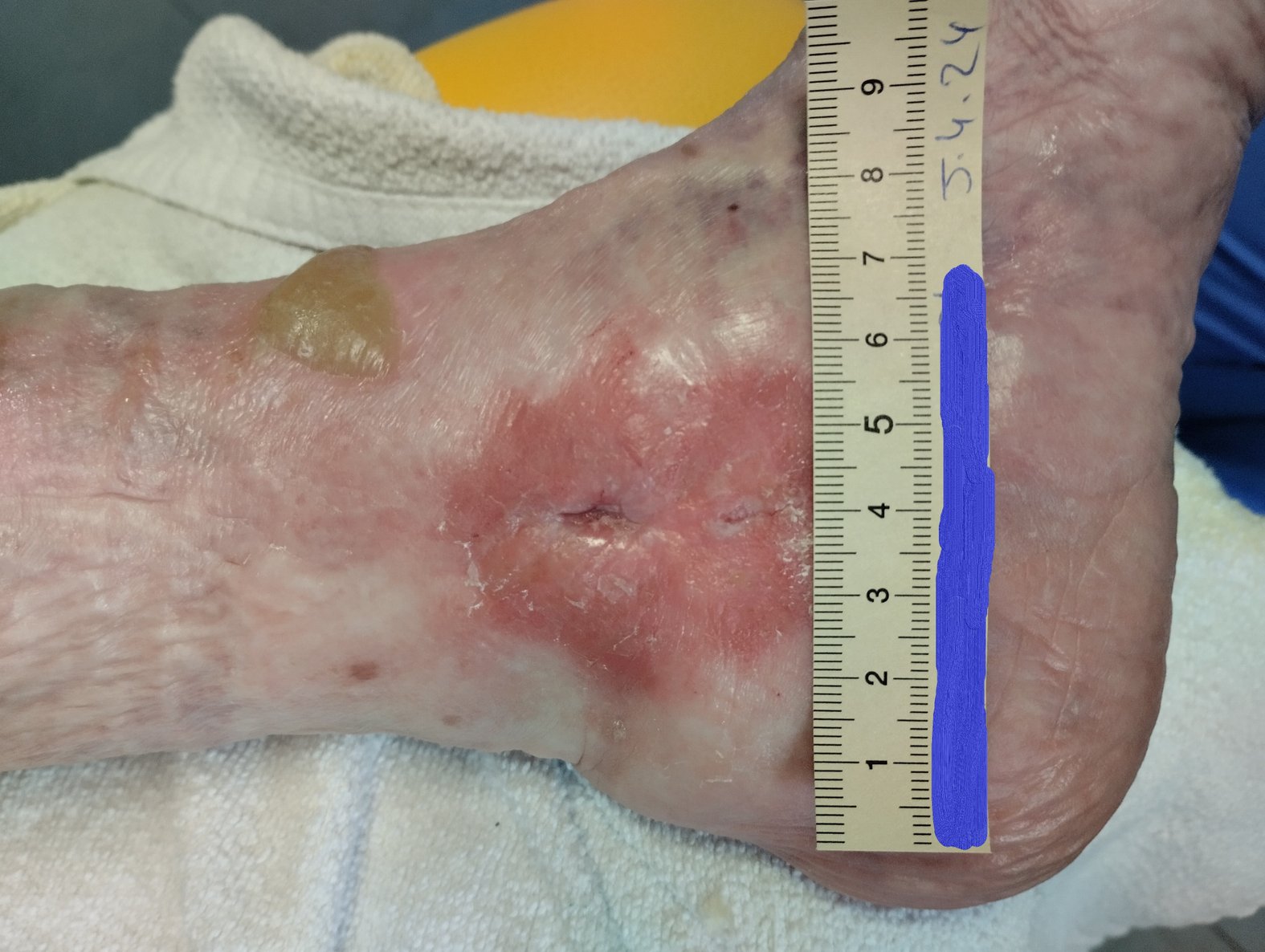 Spannungsblase neben einer Wunde am Knöchel