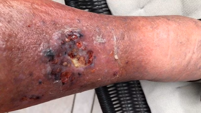Pyoderma gangraenosum