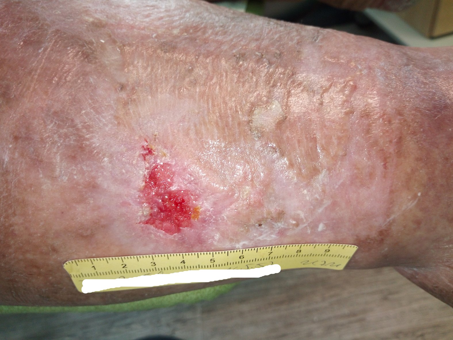 Deutlich verkleinerte Wunde, Epithelisierung stark vorangeschritten (Tag 77)