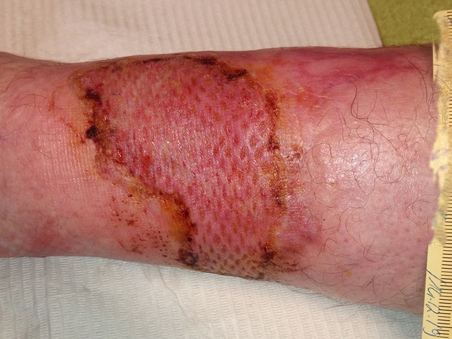 Pyoderma gangraenosum Tag 164