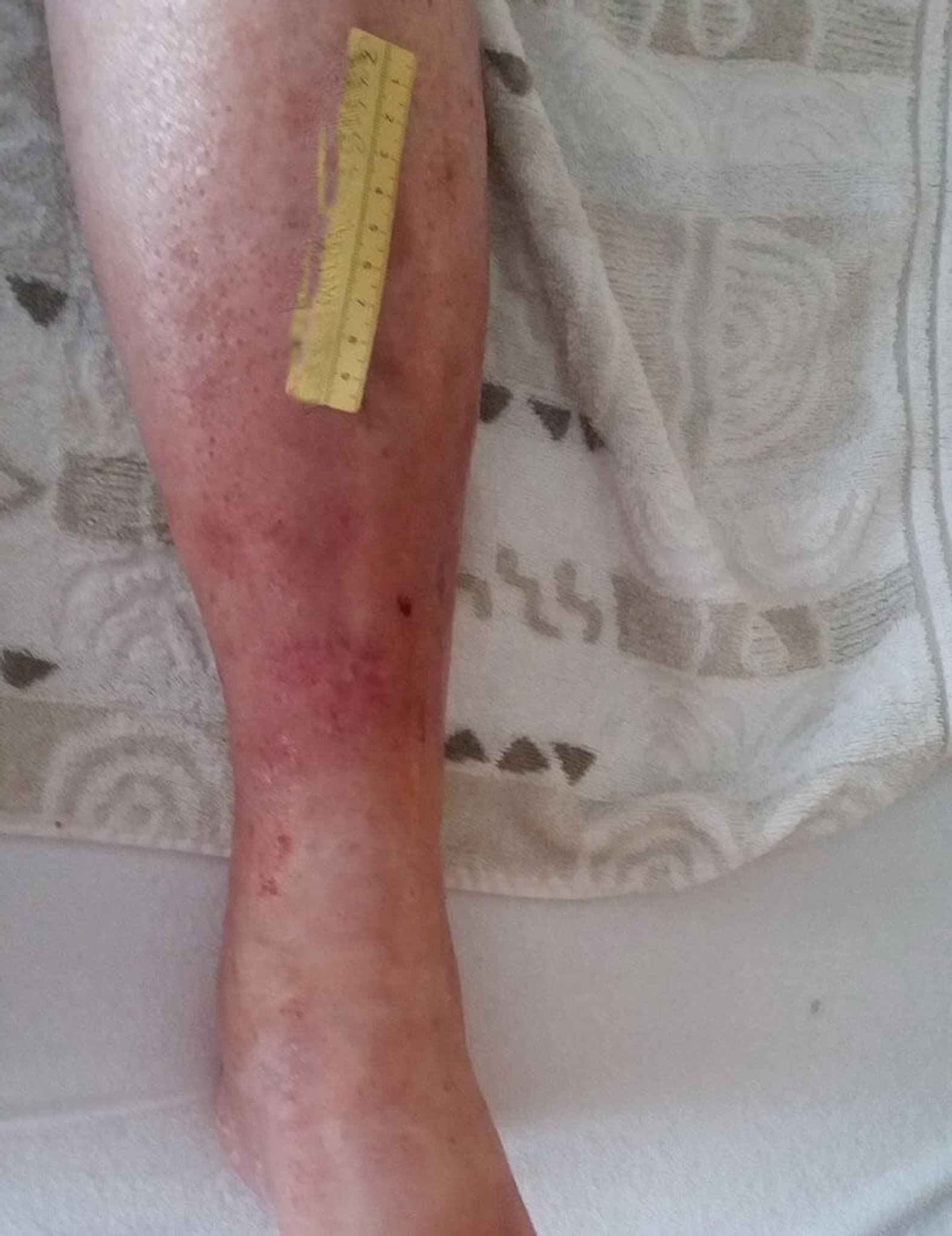 Ulcus cruris venosum nach Trauma