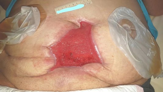 Wunddehiszenz und Stomaanlagen nach Blasentumor – Ein Fallbeispiel aus der Praxis