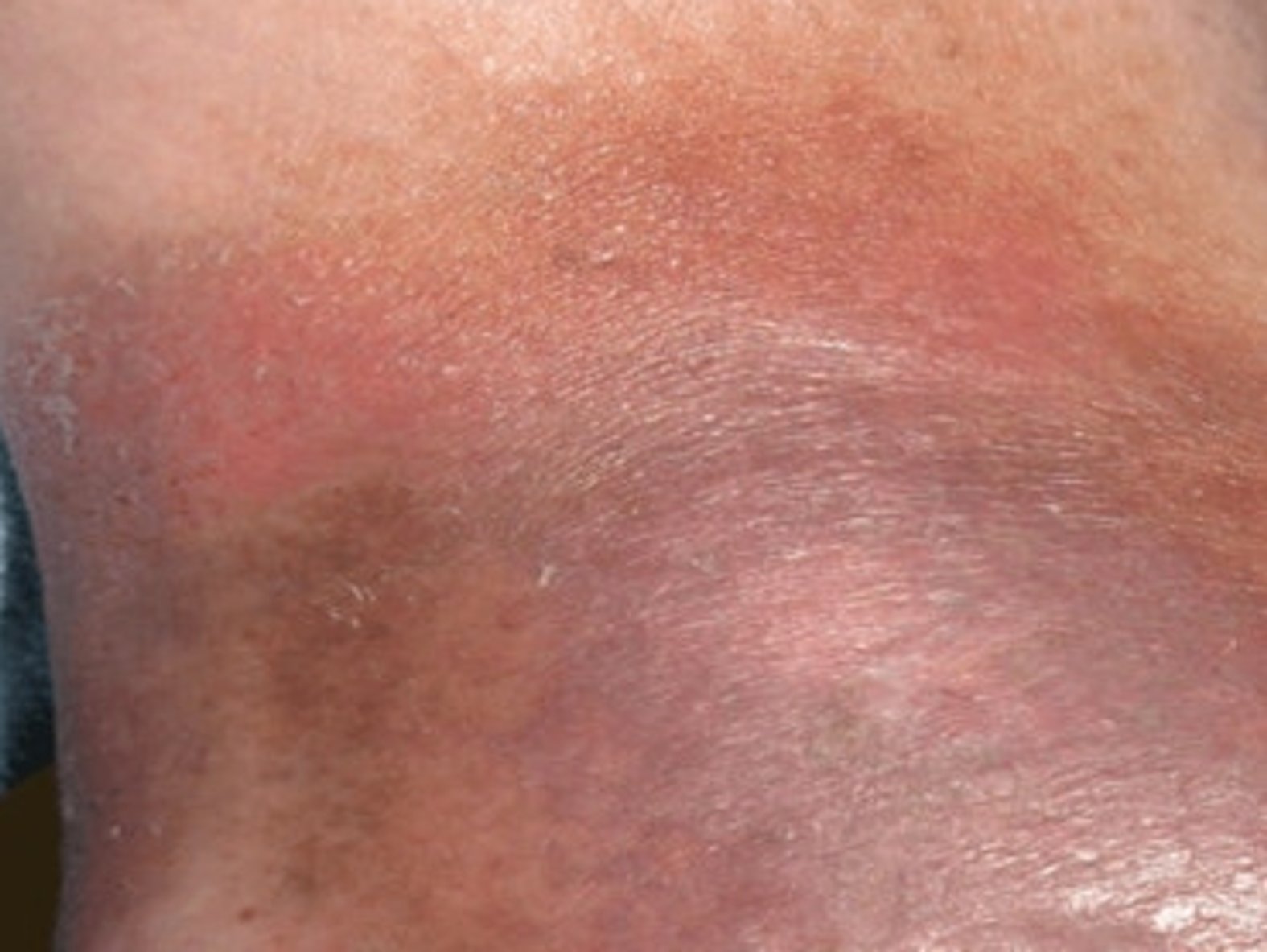 Typische Hautveränderung bei Ulcus cruris venosum