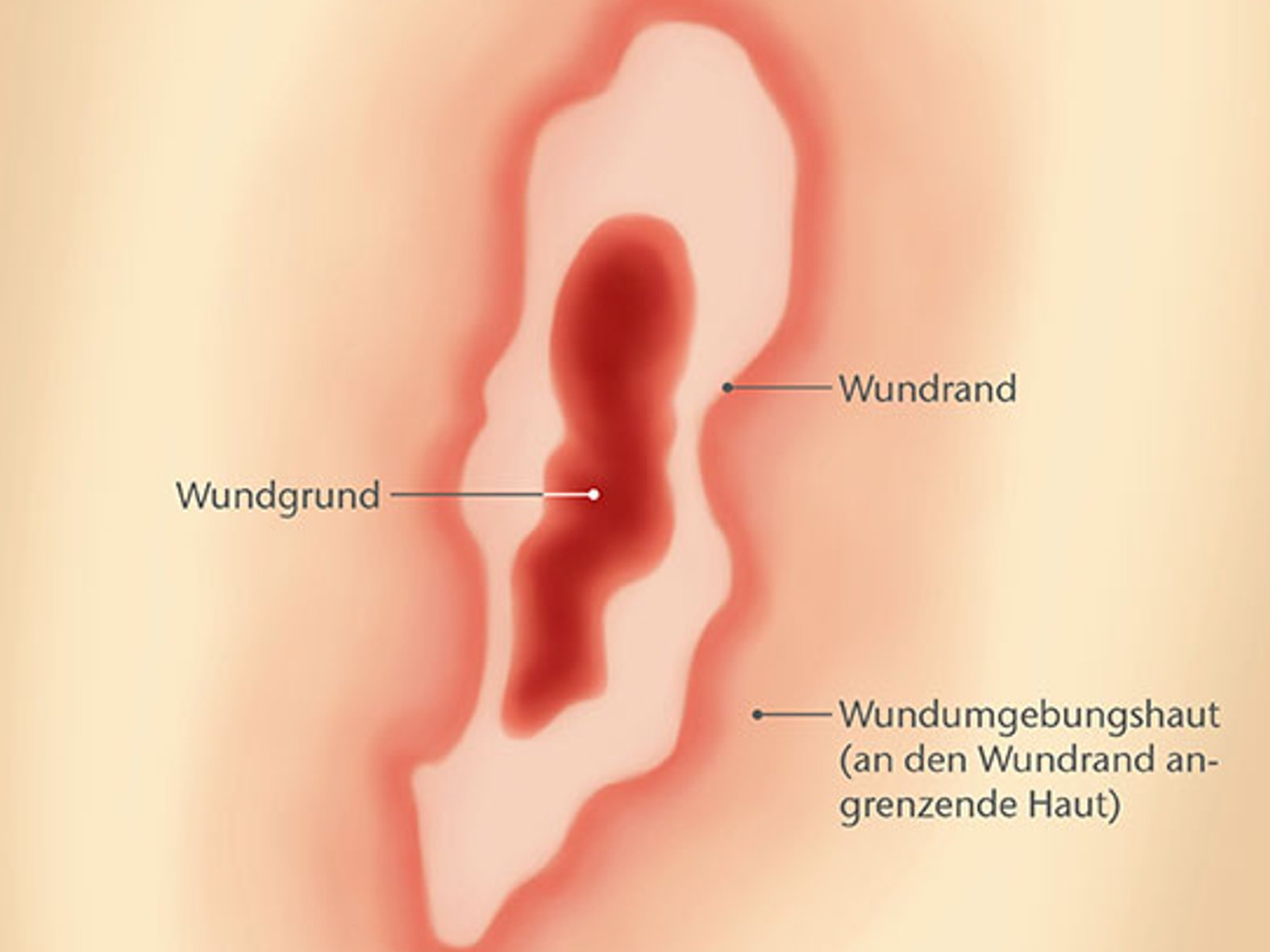 Aufbau einer Wunde grafisch veranschaulicht