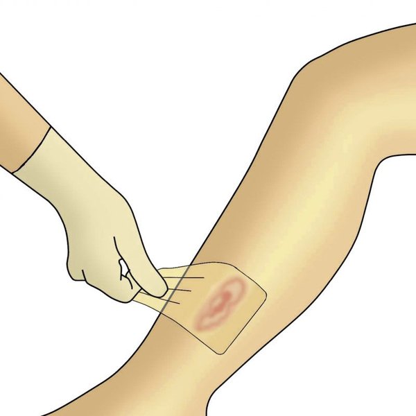 Dracohydroduenn Verbandwechsel Schritt 6