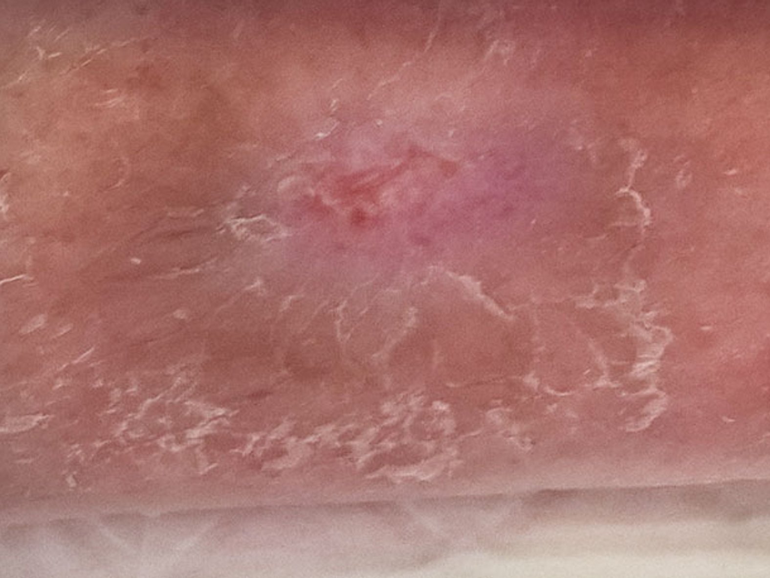 Abgeheilte Wunde (nach 7 Tagen)