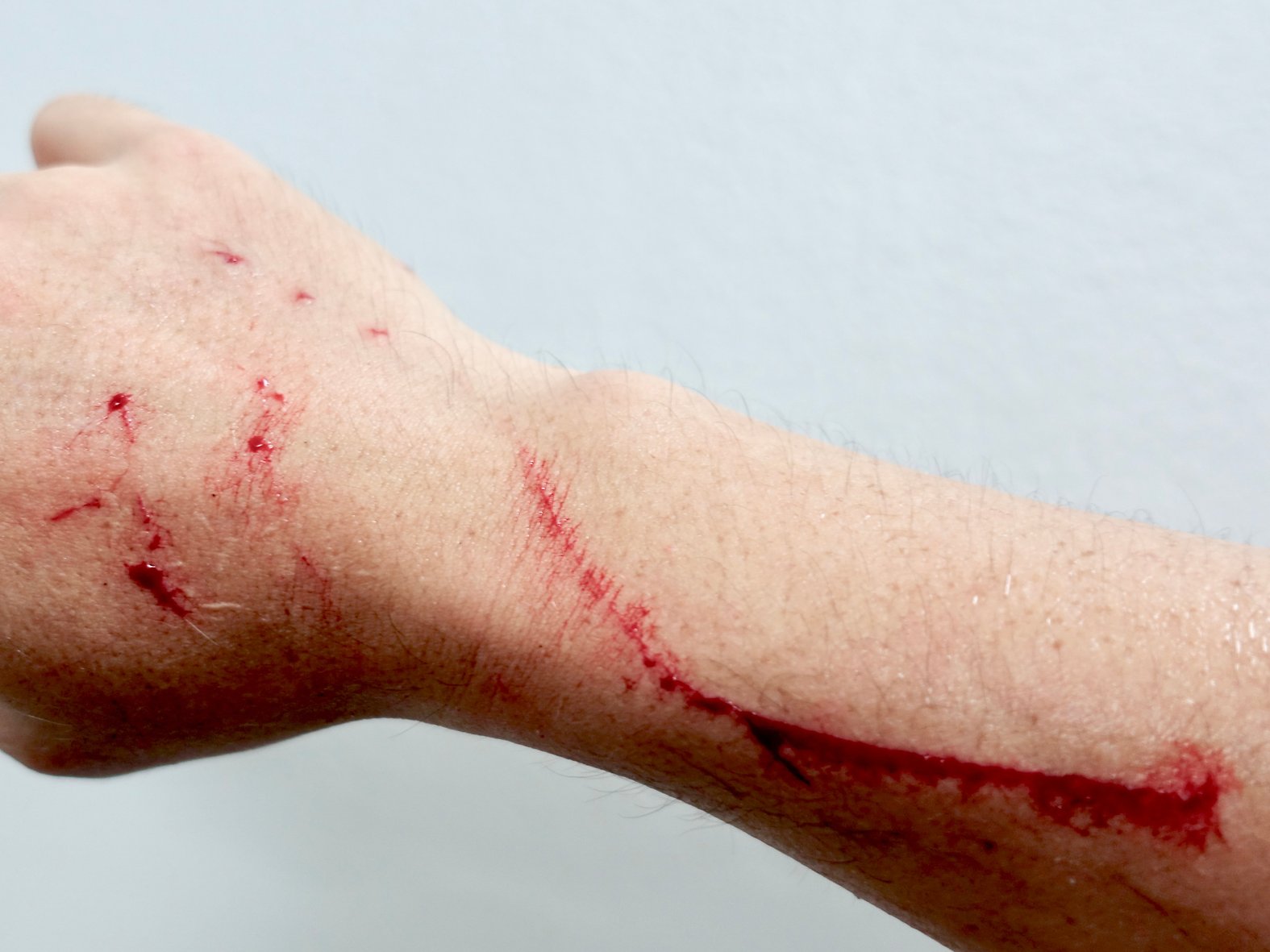 Kratzwunde durch Katze, einsetzende Blutstillungsphase