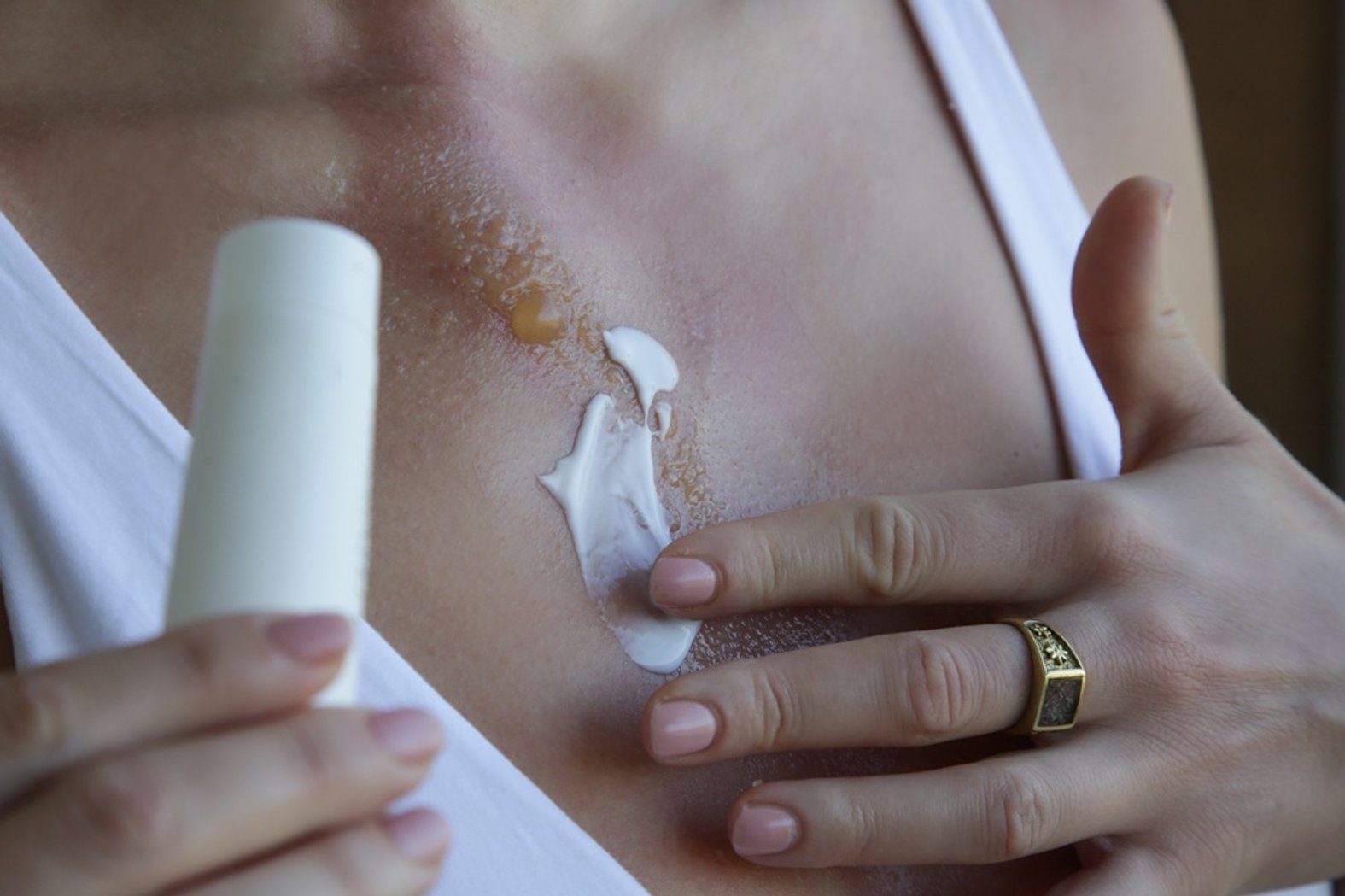 Wundpflege Verbrennungen