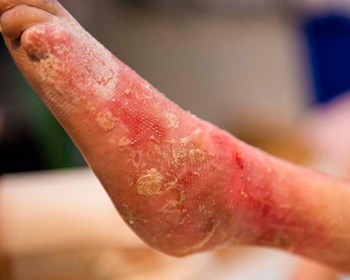 Epidermolysis bullosa – die Schmetterlingskrankheit