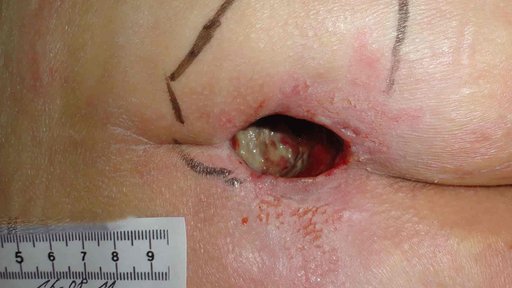 Dekubitus Lappenplastik Tag 1