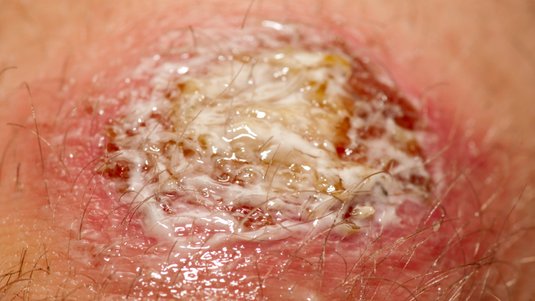 Kurz und kompakt: Belegte Wunden