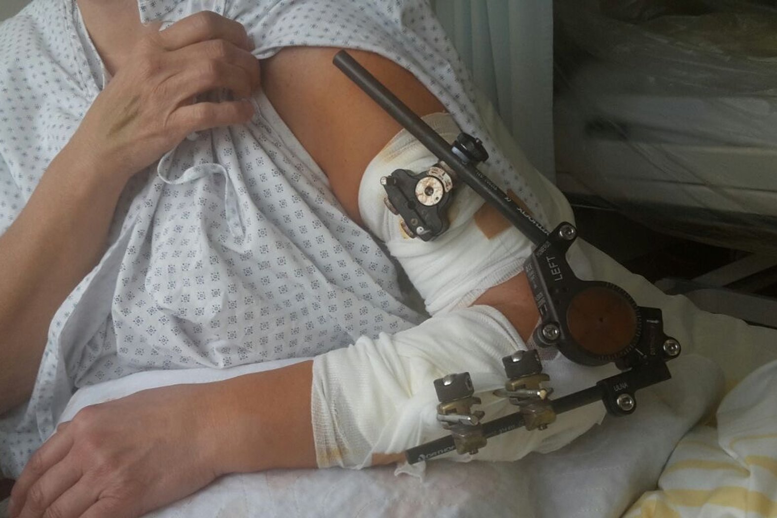 Fixateur Externe am Arm