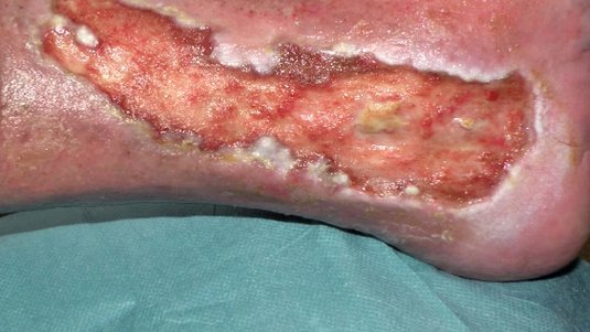 Kurz und kompakt: Wundgeruch beurteilen, therapieren und minimieren