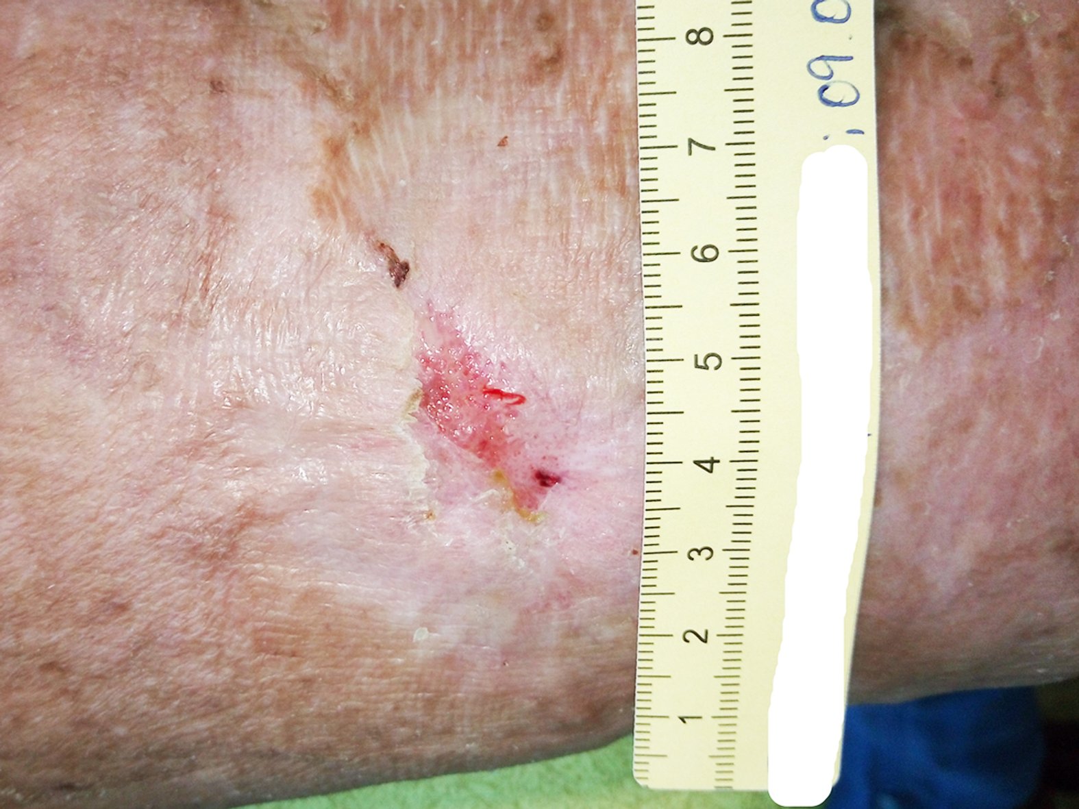 Ulcus cruris venosum, fast abgeheilt