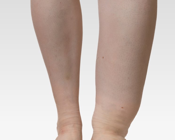 Ödeme: Arten und Ursachen von Ödemen