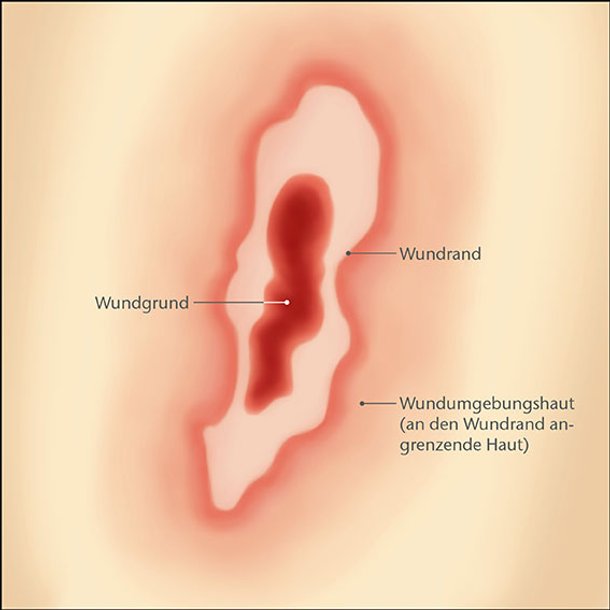 Aufbau einer Wunde grafisch veranschaulicht