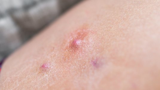 Der Feind in meinem Körper – Acne Inversa