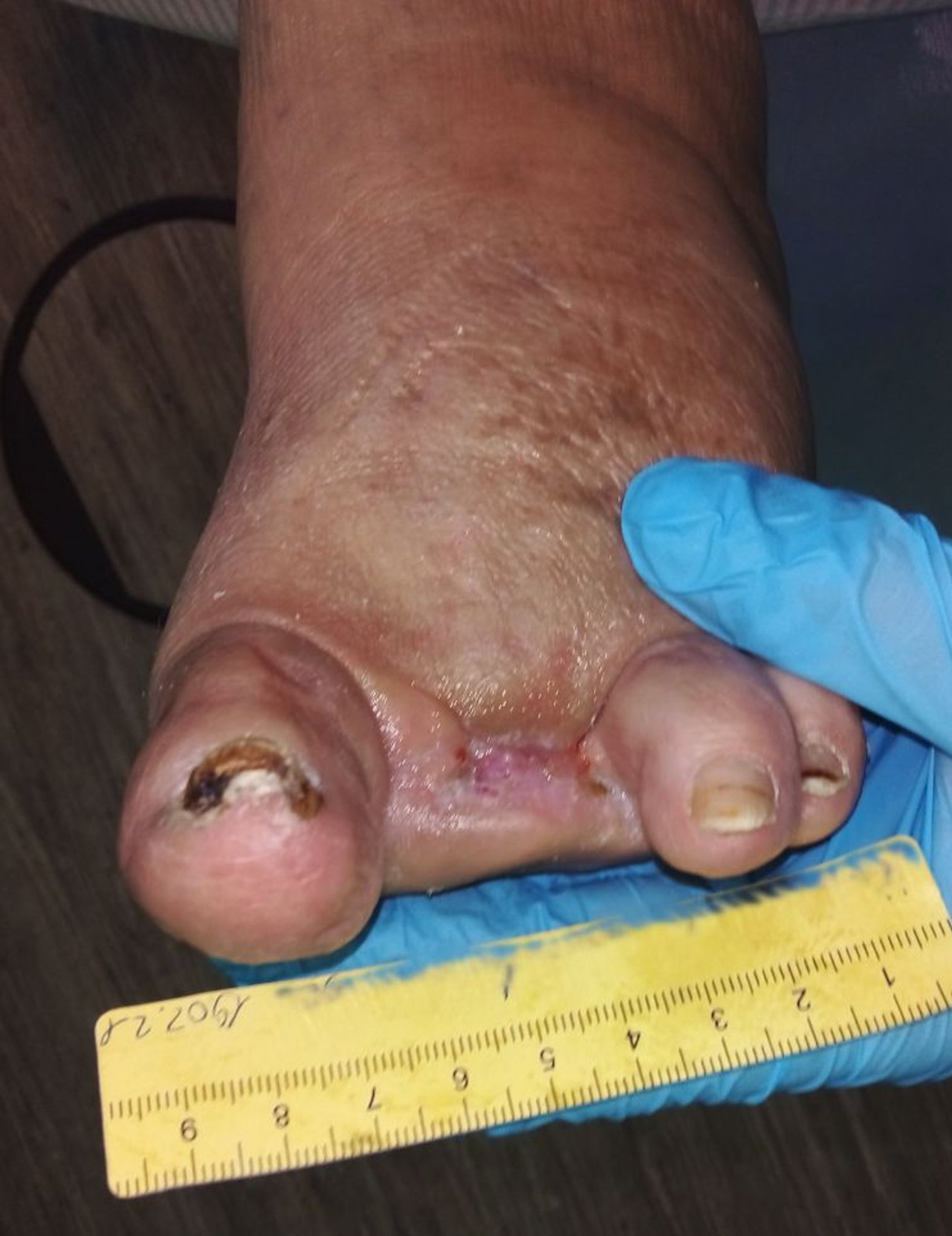 Diabetisches Fußsyndrom