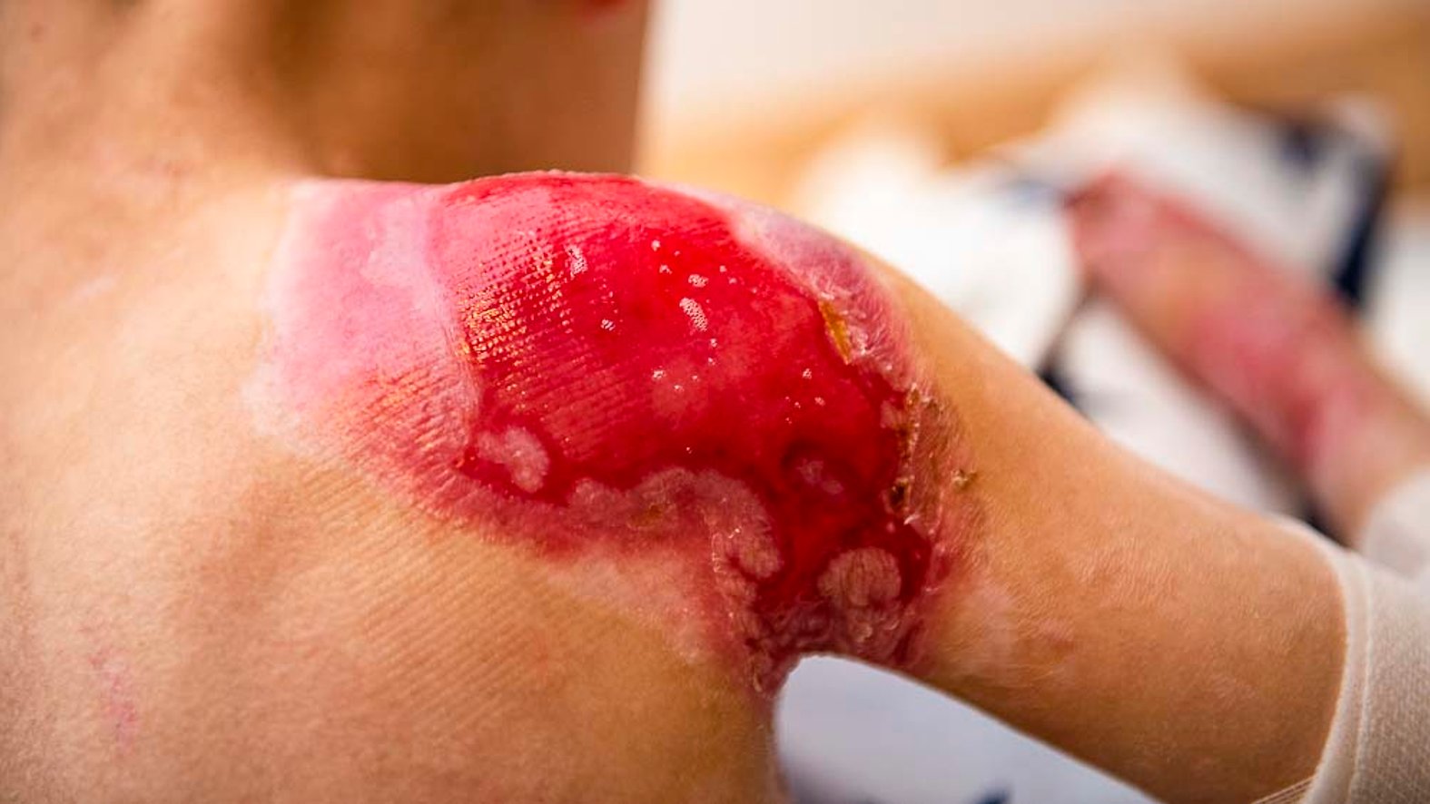 Epidermolysis bullosa, Wunde an der Schulter