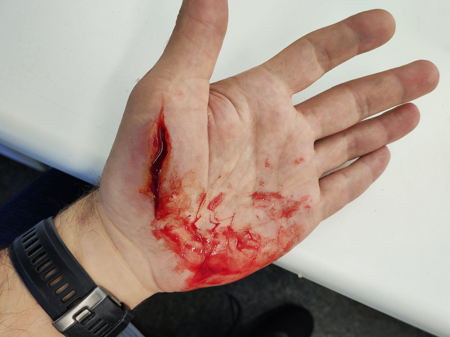 Schnittwunde an der Hand
