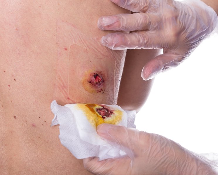 Exsudatmanagement: Videoreihen von den Grundlagen bis zum Expertenwissen