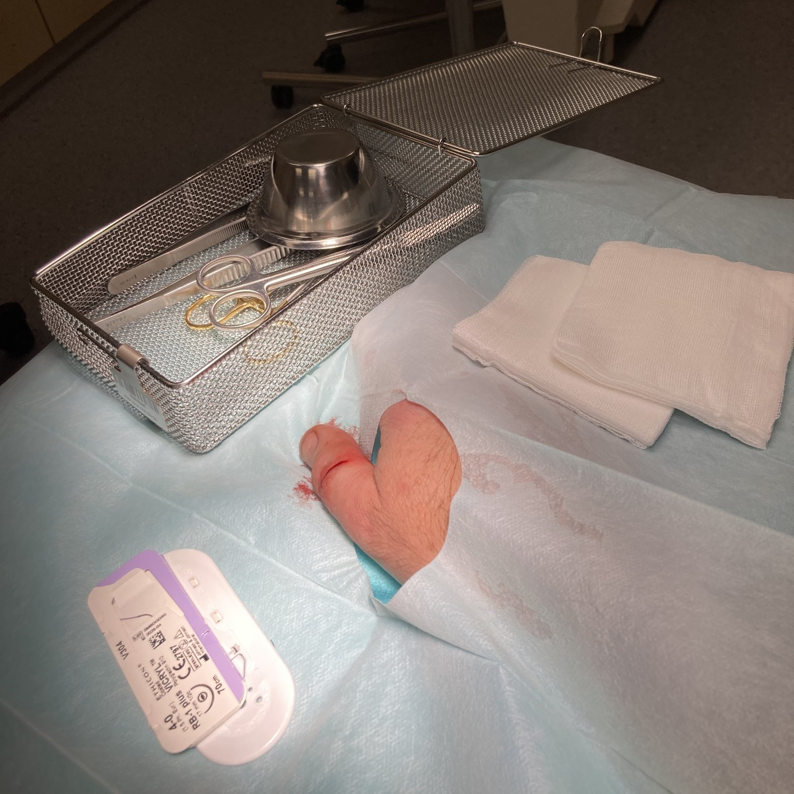 Foto 3: Wunde unmittelbar vor der OP